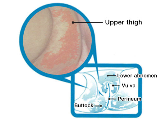 Showing diaper rash over the perineum of a baby Showing diaper rash over the perineum of a baby